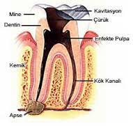 Diş pulpası nasıl iltihaplanır?